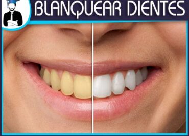 Blanquear Dientes